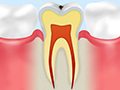CO初期むし歯