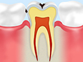 C1エナメル質のむし歯