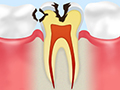 C2象牙質のむし歯