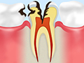 C3神経に達するむし歯
