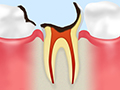 C4歯質が失われたむし歯